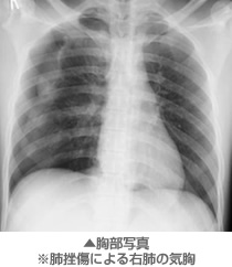 胸部写真※肺挫傷による右肺の気胸