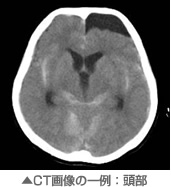 CT画像の一例：頭部