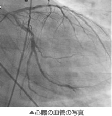 心臓の血管の写真