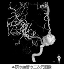 頭の血管の三次元画像