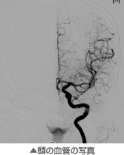 頭の血管の写真