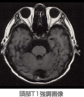 頭部T1強調画像