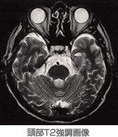頭部T2強調画像