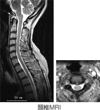 頚椎MRI