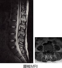 腰椎MRI
