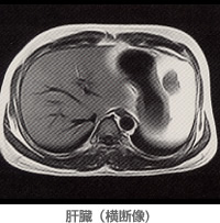 肝臓（横断像)