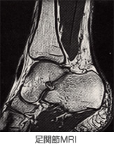 足関節MRI