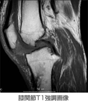 膝関節T1強調画像