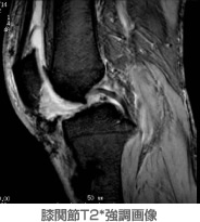 膝関節T2*強調画像
