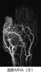造影MRA（手）