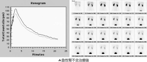 急性腎不全治療後