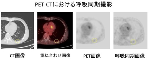 PET-CTにおける呼吸同期撮影