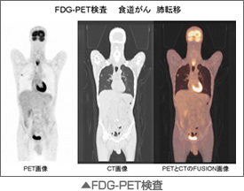 FDG-PET検査